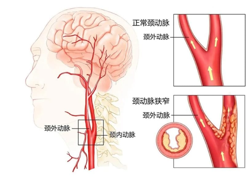 【州醫(yī)科普】劉龍生：重視頸動(dòng)脈狹窄早期治療降低卒中的發(fā)生率