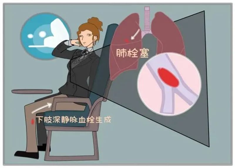 【州醫(yī)科普】關(guān)友兵：關(guān)愛血管 了解靜脈血栓的危害